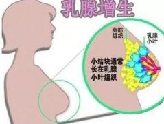 双阳鹿乡老刘家—女性乳腺增生结节就吃鹿角帽